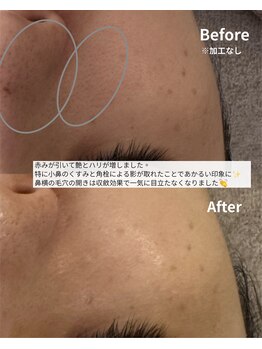 ニコ(nico)/鼻の横の毛穴って気になる。