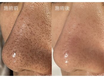 サバーイ サバーイ(SABAHI SABAHI)の写真/【黒ずみ毛穴・角栓・皮脂撃退】汚れを洗い流し、毛穴引き締め★小鼻の乾燥も同時解消★