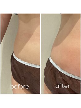 ピエルポゼ(Piereposer)/結果重視の痩身