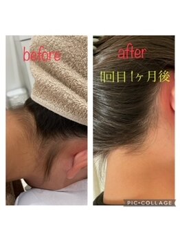 サーディン(sardine)/キッズ襟足脱毛