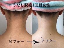 ビビ(BIBI)/うなじ脱毛