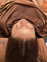 ハリファ鍼灸院 横浜関内院(HariFa鍼灸院)/美容施術