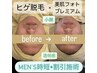 【男性】時短！ヒゲ脱＋フォトエレポレでツルピカお肌へ♪¥15,500【人気】