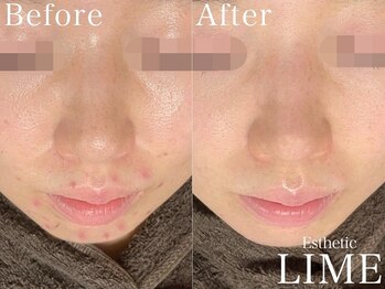 ライム 心斎橋(LIME)/ ハーブピーリング｜毛穴/ニキビ