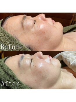 ボッカ(bocca)/水光肌乳酸菌ピーリング