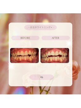 プラスビーセルフ(+b self)/ホワイトニングビフォーアフター