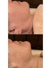 サロンツキ(salon tuki)/【ハーブピーリング】症例★