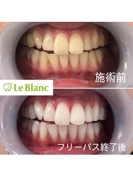 ルブラン 奈良店(Le Blanc)/たった３週間で驚きの変化！