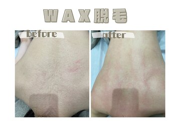 レヴィート(Revept)/【ワックス脱毛】