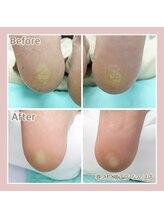 巻き爪補正店 大阪なんば店/かかとケア