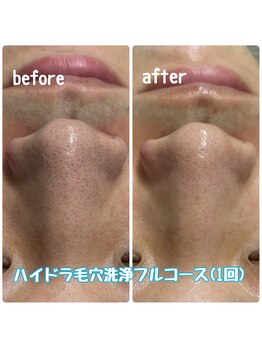 クラリ(Clari)/ハイドラ/毛穴洗浄/大濠エステ