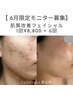【6月限定肌質改善モニター募集】頑固なニキビ肌荒れケア/1回8800円×6回