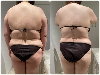 イデアルミー 大宮店(イデアルMe)/痩身エステ3ヶ月間Before　After