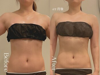 ユーフォリア グロウ(euphoria glow)/{ ラフォス痩身90分24回 }