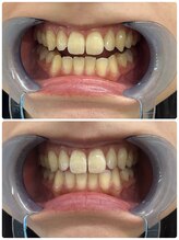 グリッター ショウナン(glitter. SHONAN)/藤沢ホワイトニングbefore/after