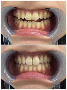 グリッター ショウナン(glitter. SHONAN)/藤沢ホワイトニングbefore/after