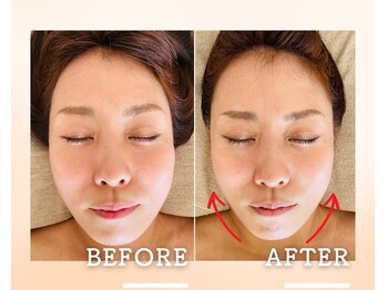 トレボ 福岡天神(TREVO)/小顔・リフトアップもお任せ！