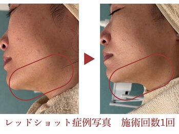 ロベリア(LoveliA)/顎下・眼窩・Ｆラインのたるみに