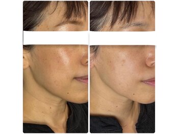 ラローズ(La Rose)/韓国シワたるみケア★サーマガン