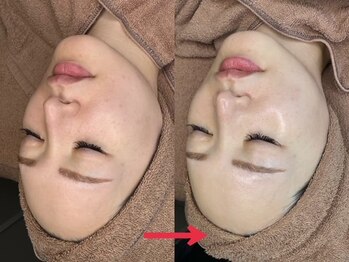 ナチュラックスビューティー 恵比寿店(NaturaxBeauty)/ララピールで速攻ツヤ肌