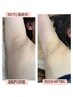 【全身脱毛＋顔＋ＩＯ込み】お顔パック仕上げ/美肌脱毛でつるすべ肌へ★