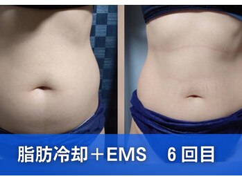 スリム(SLIM by lily of the valley)/腹退治！