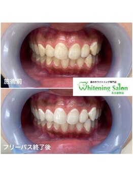 ホワイトニングサロン 名古屋駅店/【ホワイトニング施術例】