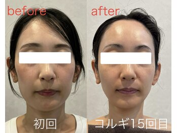 ビーキュート 姫路店(BE-CUTE)/小顔コルギ15回目