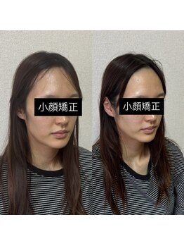 ルピナス 立川店/小顔矯正