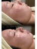 【しわ、くすみ】年齢肌にお悩みの方ヒト幹細胞導入+デコルテヘッドスパ70分