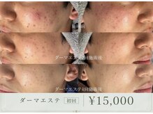 ベネミー 恵比寿(Benemi)の雰囲気（しぶといニキビケアには、ダーマエステがおすすめ！初回￥15,000）