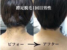 ビビ(BIBI)/襟足脱毛