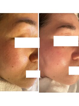 美バストアルファ(美bust α)/【シミ改善】