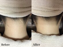 ラウレア 松山店(LAULEA)/襟足脱毛（before/after）