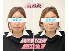 ウル鍼灸整骨院/美容鍼ビフォーアフター