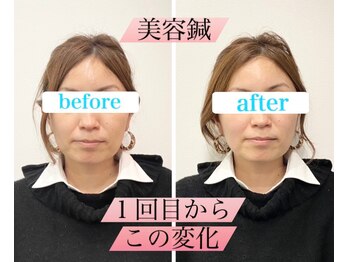 ウル鍼灸整骨院/美容鍼ビフォーアフター