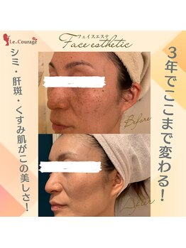 ル クラージュ(Le..Courage)/４２歳美肌へ改善プログラム◎