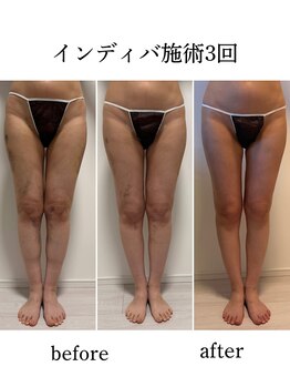 ワンエストサロン(One est.salon)/太ももbefore after