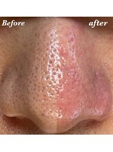 ジューンブライド(June Bride 61)/毛穴エクストラクション