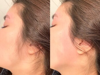 ワクシングトウキョウアイス 北千住西口店(waxing tokyo ice)/もみあげ