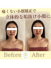 リコ(Rico)/理想のスッキリフェイスラインに