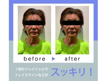 マルク(MARQUE)/リフトアップ&ほうれい線除去!!