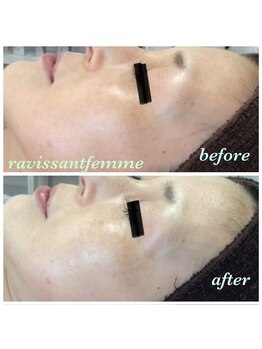 ラヴィソンファム(Ravissant femme)/40代1回効果/肌質改善