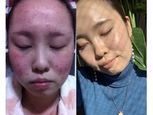 リベル(ReBelle.)の雰囲気（血まみれニキビも徹底ケア◎今はノーファンデ生活です(^^)）