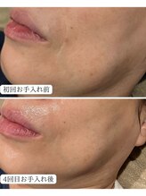 アンドニューリー(&NEWLY)/水玉リフティング　Before After