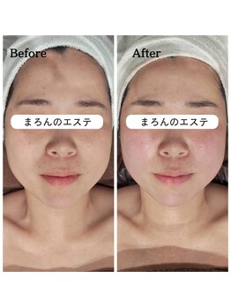 まろんのエステ/30代 小顔コルギ