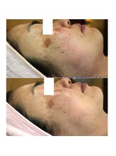 アモリアージュ(Amolliage)/しみ改善