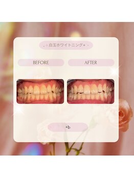 プラスビーセルフ(+b self)/ホワイトニングビフォーアフター
