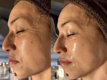 アンティアージュ 福岡本店(antiage)/気になる目尻のシワも解決！