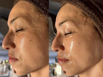 アンティアージュ 福岡本店(antiage)/気になる目尻のシワも解決！